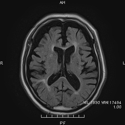 前頭側頭型認知症のMRI画像
