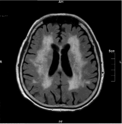 血管性認知症のMRI画像